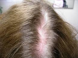 Hair Grow Max - effetti collaterali - controindicazioni 